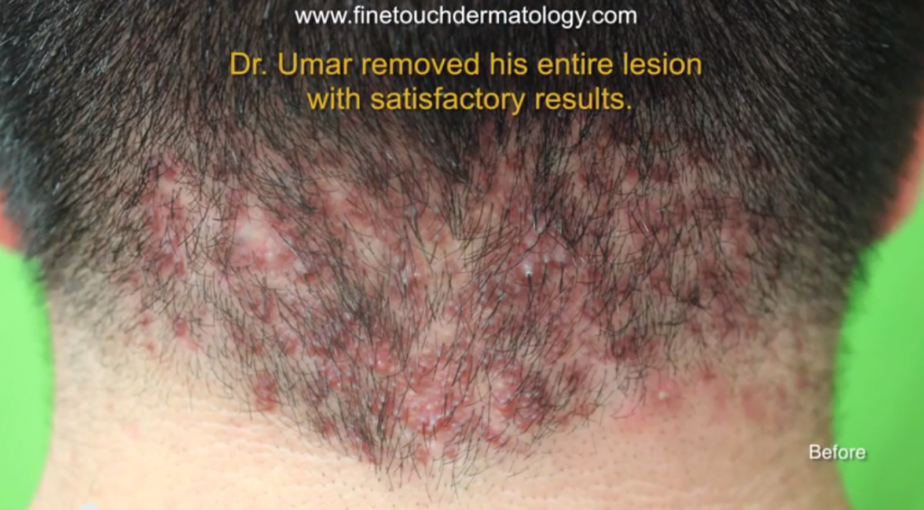 akn-surgery-results-for-scalp-bumps