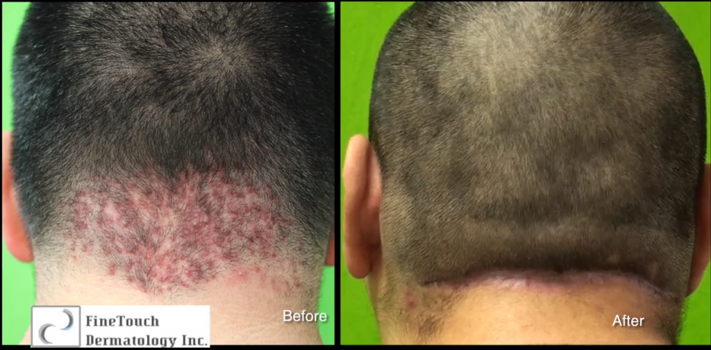 AKN Surgery Results For Scalp Bumps